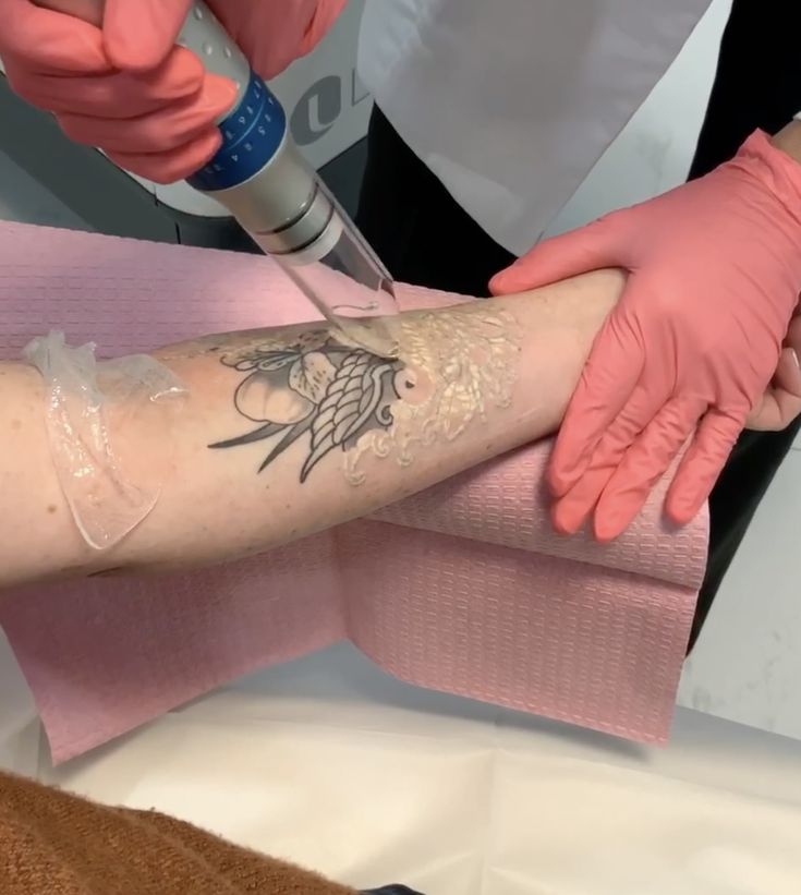 Laser Removal Tattoo Near me