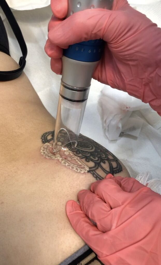 Laser Removal Tattoo Near me