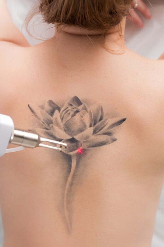 Laser Tattoo Removal