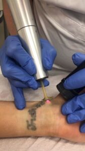 Tattoo Removal Healing Process