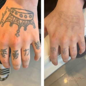 Tattoo Removal Healing Process